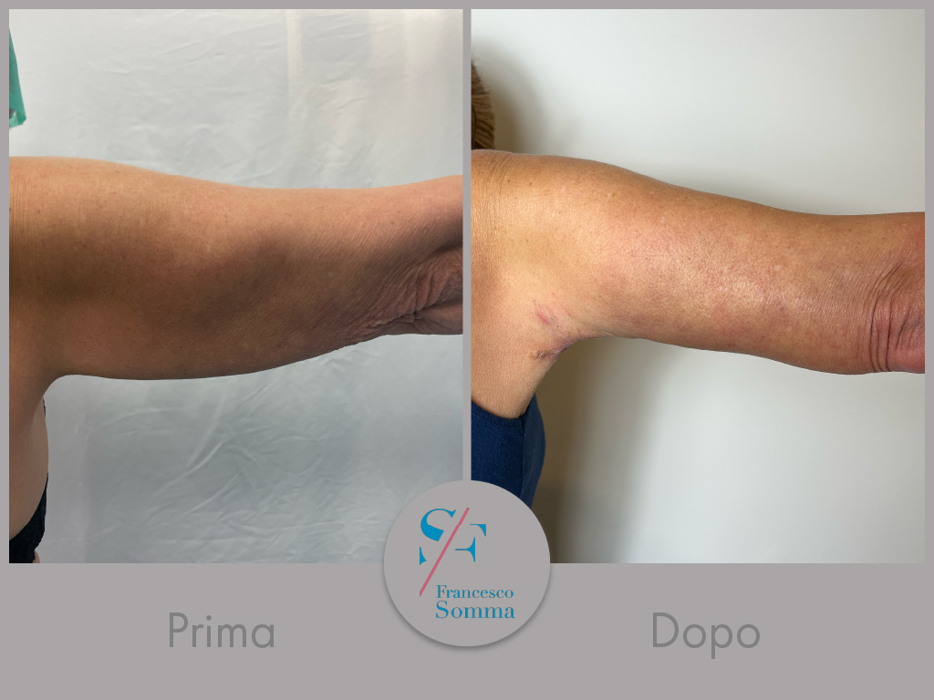 10 Pcs Lifting Istantaneo delle Cosce, di Nastro Trasparente per il 10 Pcs Lifting Istantaneo delle Cosce, di Nastro Trasparente per il